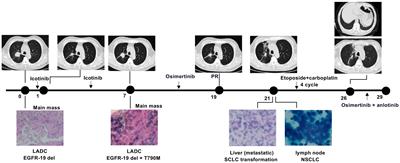 Clinical and molecular profiling of EGFR-mutant lung adenocarcinomas transformation to small cell lung cancer during TKI treatment